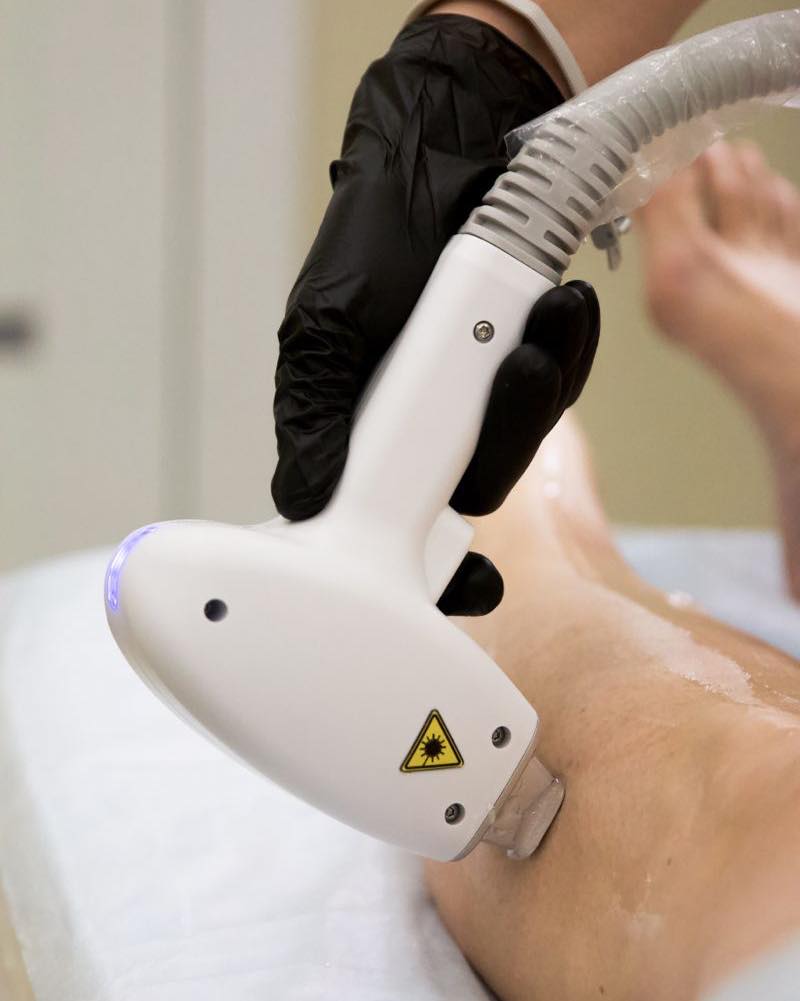 Epilazione Laser